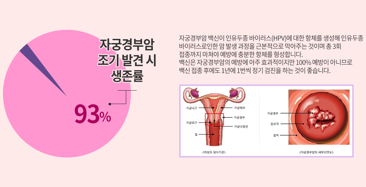 자궁경부암의 생존률 93%